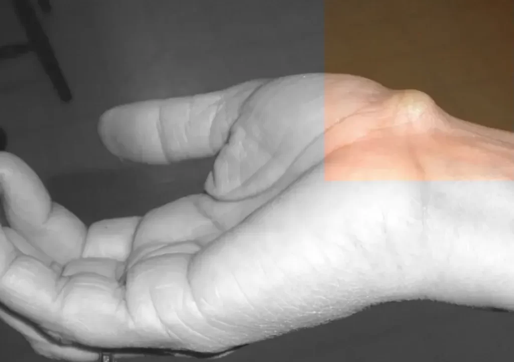 Ganglión de muñeca