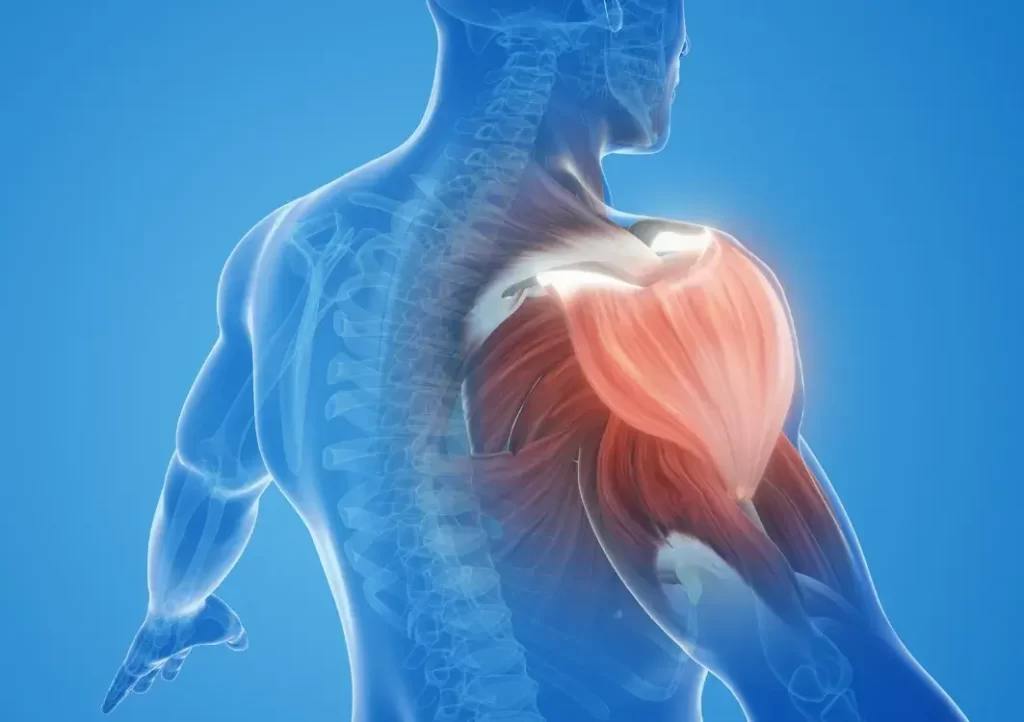 Tipos de lesiones musculares en el fitness