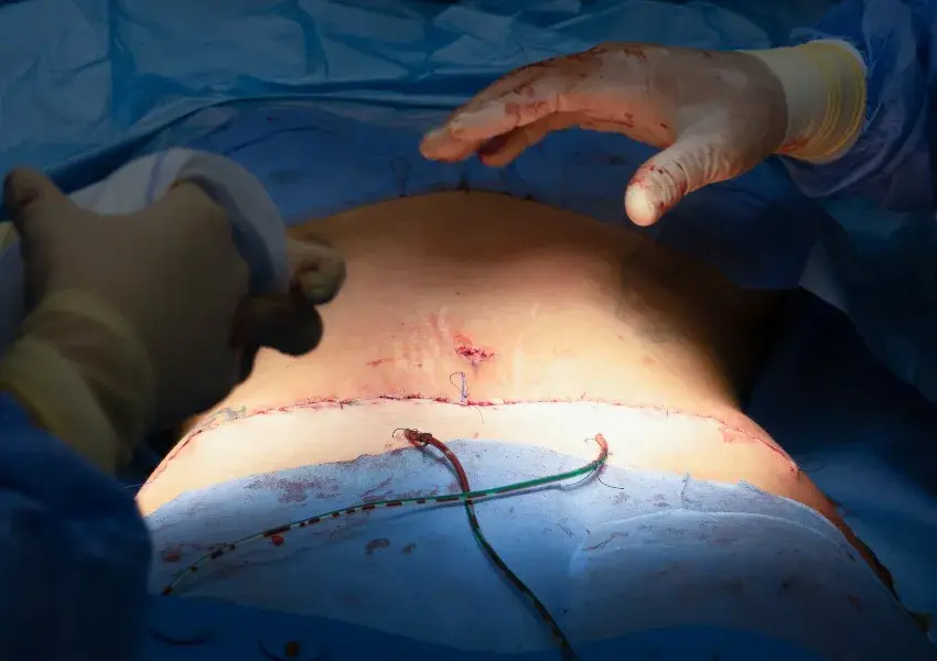 Abdominoplastia Recuperación